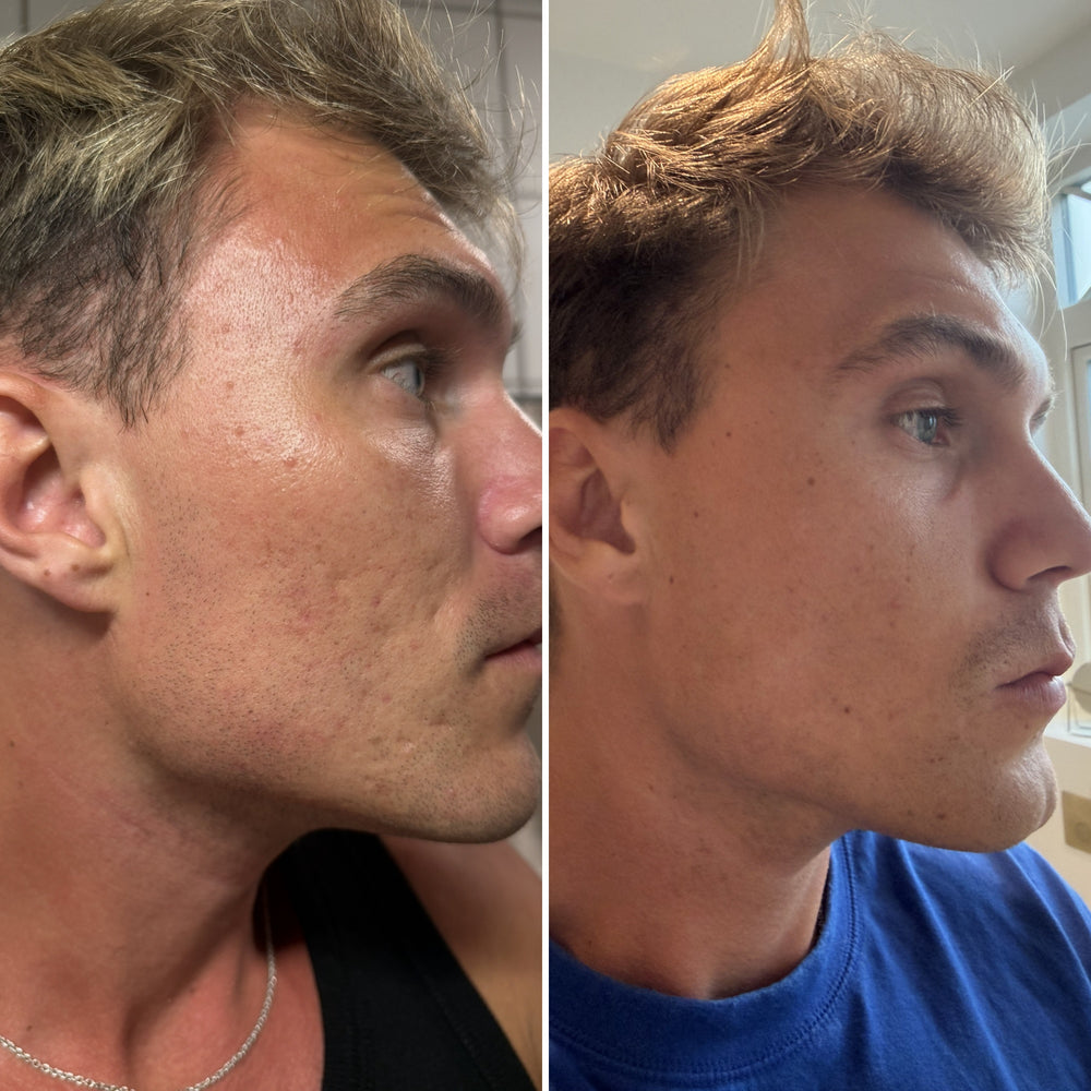 Emilin iho ennen ja jälkeen microneedlingin