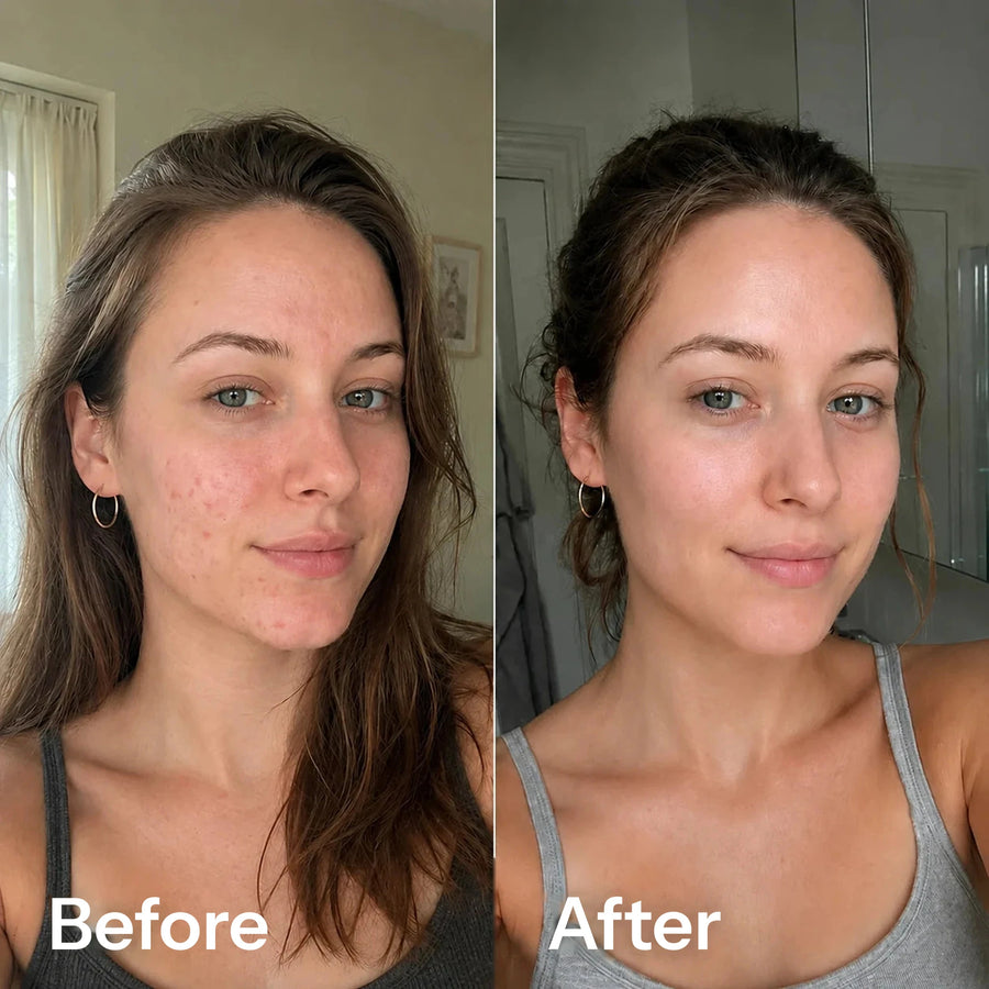 Before and after microneedling: the same woman with uneven, blemished skin and later smoother, clearer skin