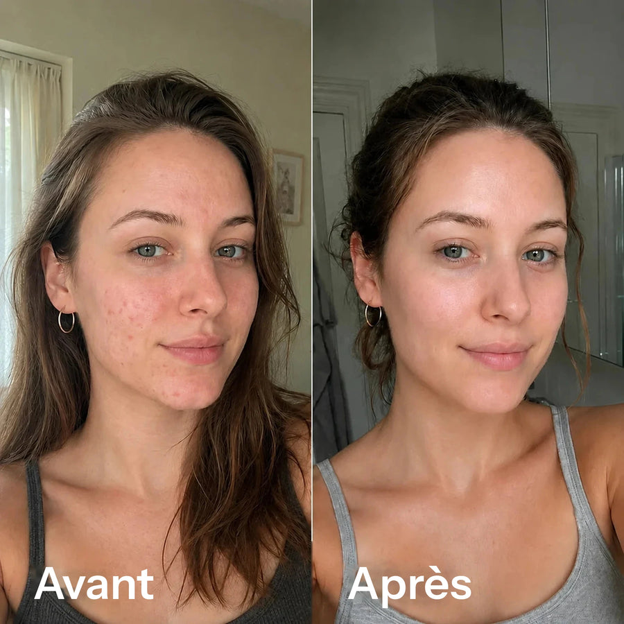 Avant/après microneedling : la même femme, d’abord avec une peau irrégulière et marquée d’imperfections, puis avec une peau plus lisse et plus nette