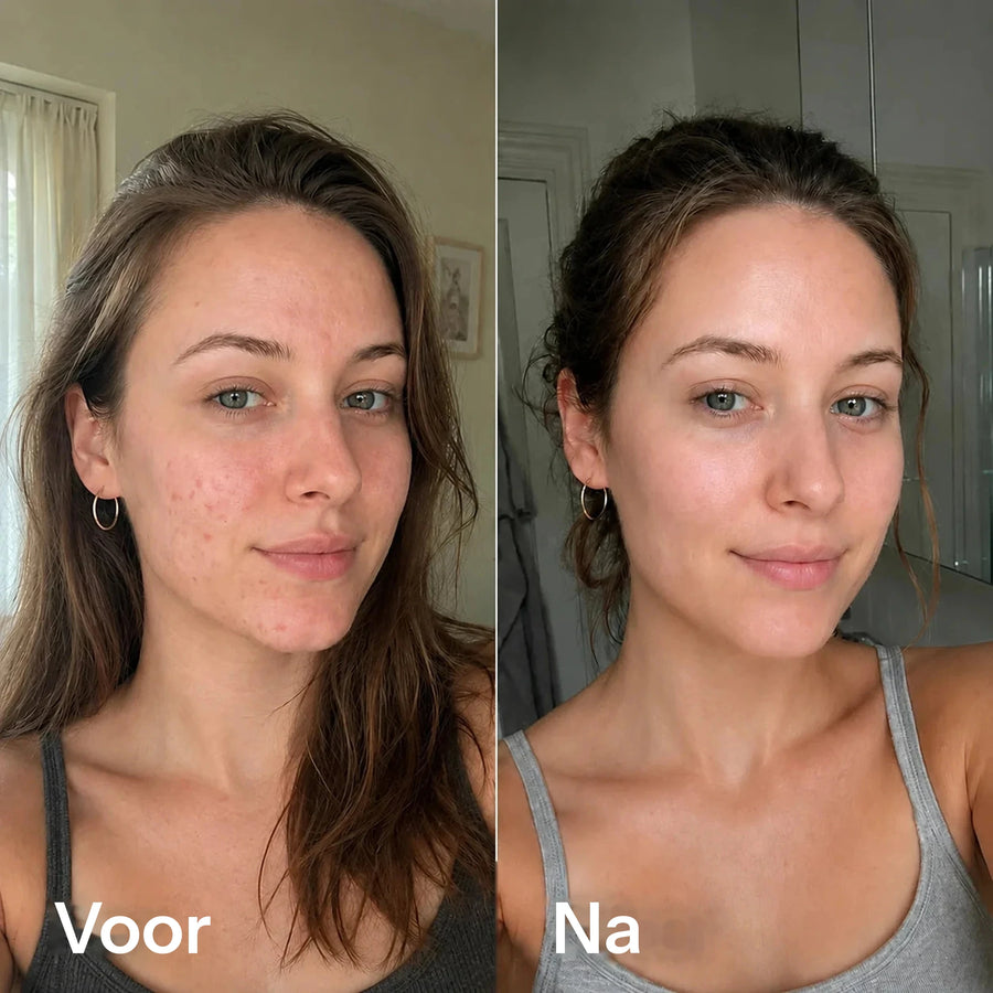 Voor en na: dezelfde vrouw met een onrustige, oneffen huid en later een gladdere, egalere huid